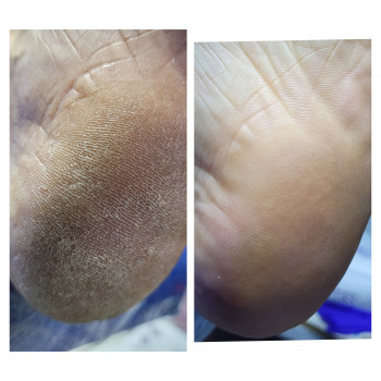 Грибкові стопи