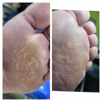 Обробка плюсневої зони деформованої стопи за рахунок опущенн