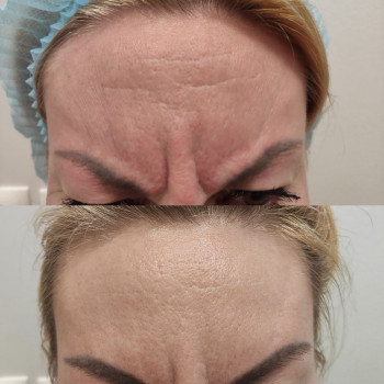 Ботулінотерапія
                    Косметолог Людмила Киев