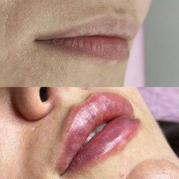 Контурна пластика губ
                    Косметолог Людмила Киев