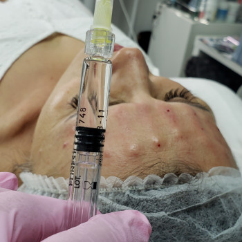 Біоревіталізація
                    Косметолог Лілія Ровно