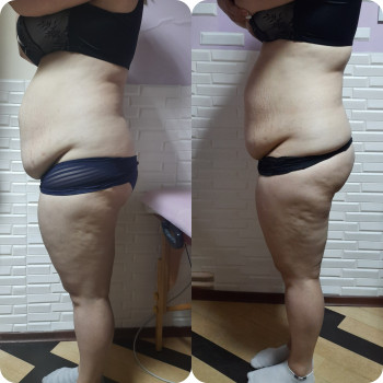 Программа похудения "Стройность и красота!"
                    Косметологічний центр Майстерня краси та здоров'я Slim Дніпро