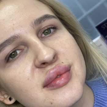 Увеличение губ контурная пластика
                    Косметолог Анна Гарич Днепр