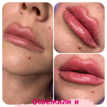 Аугментація (збільшення) губ