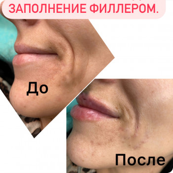 Контурна пластика