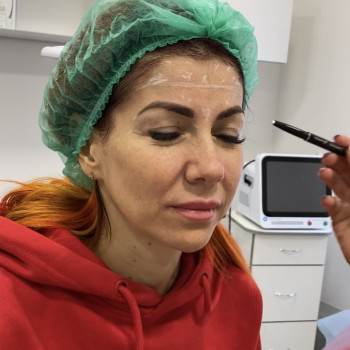 Ботулінотерапія