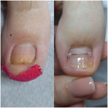 Врослий ніготь
Скрученний ніготь
    
 
 
 
 
 