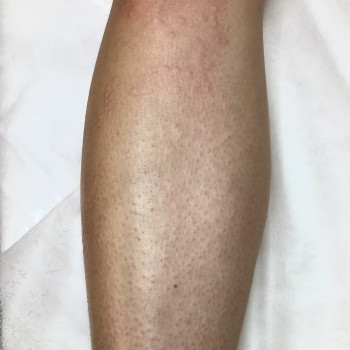 Сразу после процедуры, фото - мастер депиляции Кристина Искра