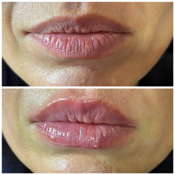 0,5 мл ? результат залежить від техніки?