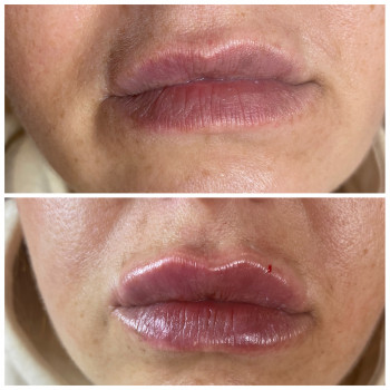 Корекція форми губ. Виправлення асіметріі