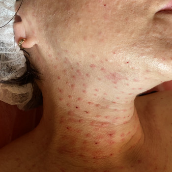 При кейсі обличчя+ шия + декольте = біоревіталізація ручок у