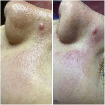 Підліткова чистка+ поверхневий пілінг