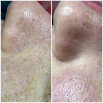 Чистка + карбоксітерапія