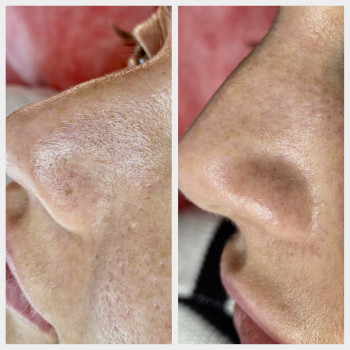 Комбінована чистка обличчя + пілінг