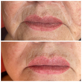 Контурная пластика лица (скулы, носослезная борозда, носогубная складка, подбородок)
                    Косметолог Юлия Харьков