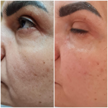 Контурная пластика лица (скулы, носослезная борозда, носогубная складка, подбородок)
                    Косметолог Юлия Харьков