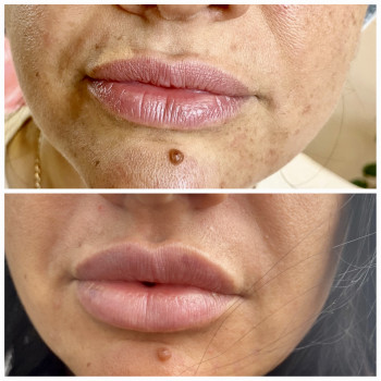 Контурная пластика лица (скулы, носослезная борозда, носогубная складка, подбородок)
                    Косметолог Юлия Харьков