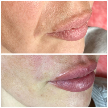 Контурная пластика лица (скулы, носослезная борозда, носогубная складка, подбородок)
                    Косметолог Юлия Харьков