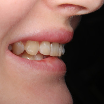 Вініри Керамічні
                    Стоматолог Максим Ужгород