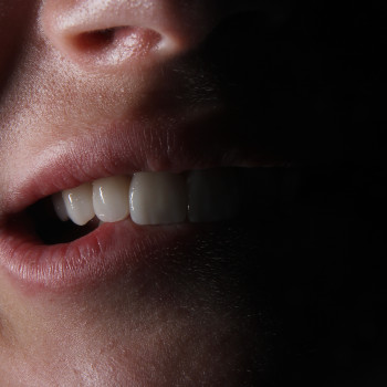 Вініри Керамічні
                    Стоматолог Максим Ужгород