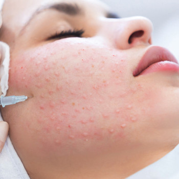 Мезотерапия лица
                    Косметолог-ін'єкціоніст Вероника Одеса