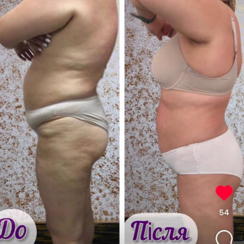 LPG- масаж
                    Салон краси Энжой Запоріжжя