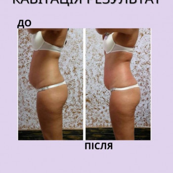 Кавітація 1 зона
                    Салон красоты Энжой Запорожье