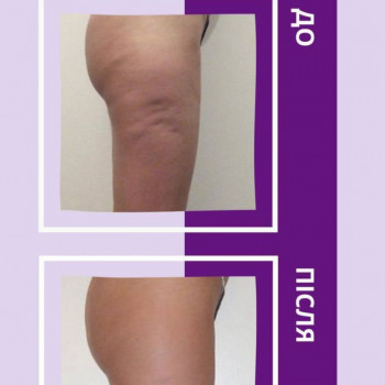 Кавітація 2 зони
                    Салон красоты Энжой Запорожье