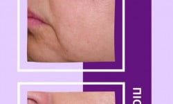 RF-лифтінг обличчя Салон красоты Энжой Запорожье