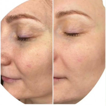 RF-лифтінг обличчя
                    Салон красоты Энжой Запорожье