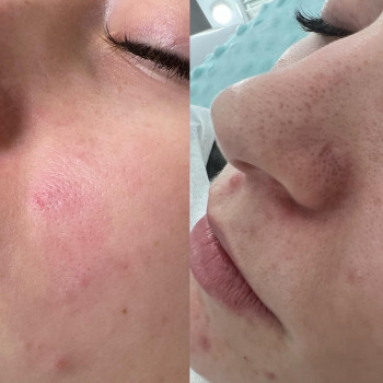 Чистка лица
                    Косметолог-инъекционист Наталья Днепр