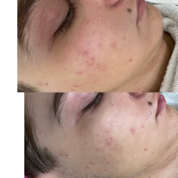 Чистка лица
                    Косметолог-инъекционист Наталья Днепр