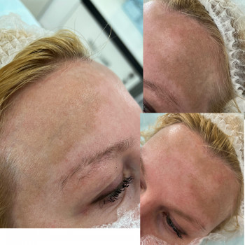 Лікування пігментних пʼятен кислотними пілінгами