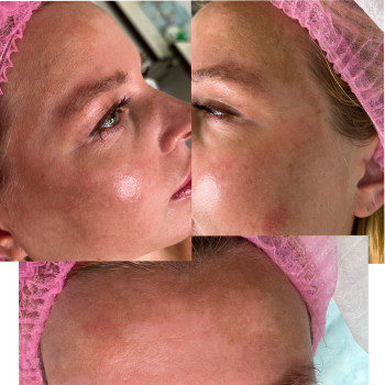 Пілінги
                    Косметолог-инъекционист Наталья Днепр