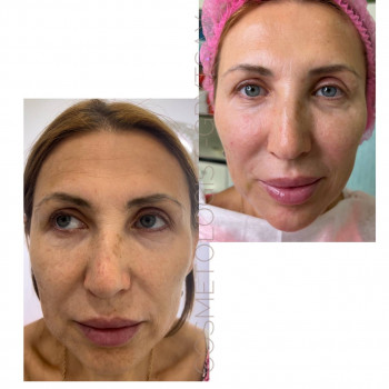 Щічки-яблука # 
Фуллфейс #
Уколыкрасоты #