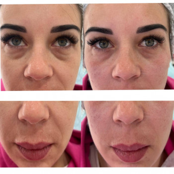 Корекція середньої третини обличчя
                    Косметолог-инъекционист Наталья Днепр