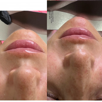 Корекція підборіддя
                    Косметолог-ін'єкціоніст Наталья Дніпро