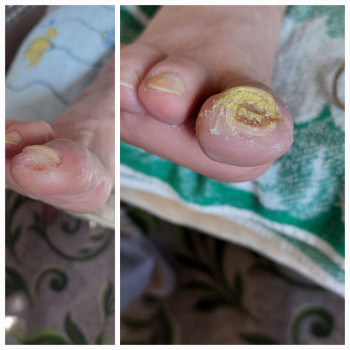 Діабетична стопа