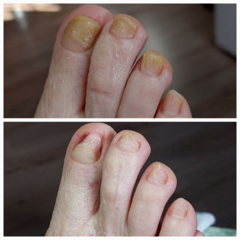 Обробка стопи діабетика