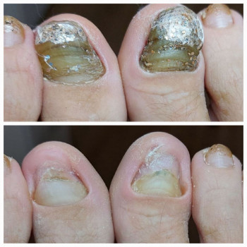 Обробка грибкових нігтів