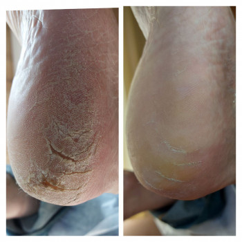 Обробка стопи