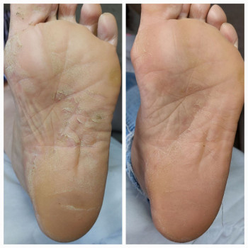 Лікування шкіри стопи