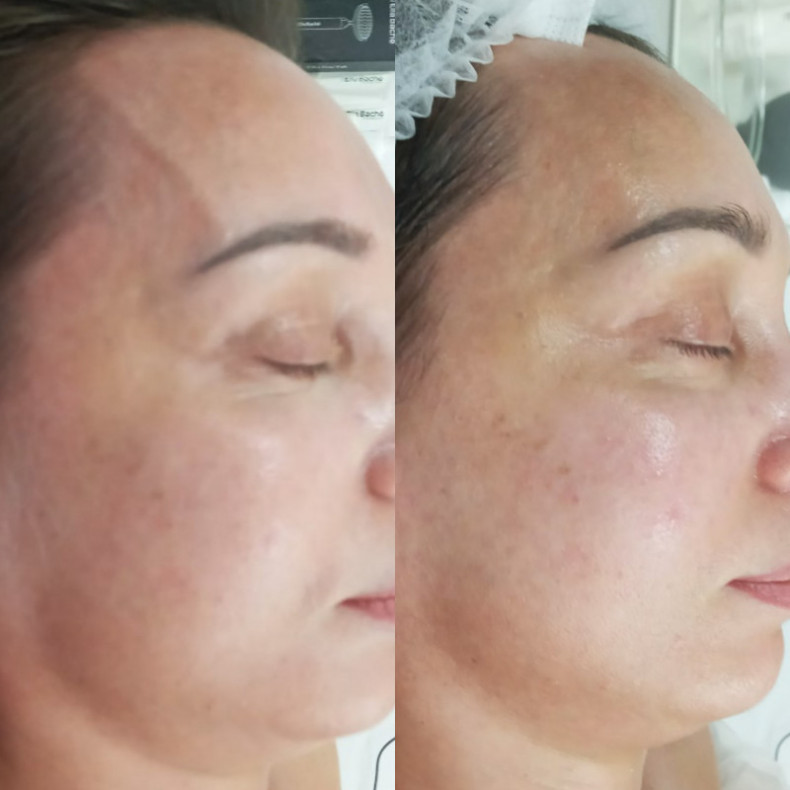 Уходная процедура grèen fill омоложение 30+, фото - Косметолог-эстетист Светлана Халаим