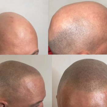 фото до процедури, та результат після 2 процедур.