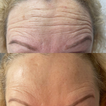 Результат процедури через 10 днів.