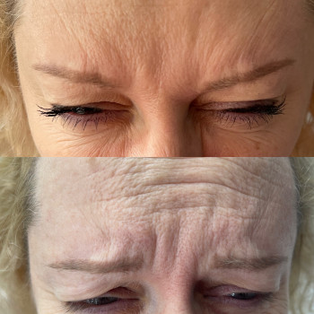 Результат після процедури через 10 днів.