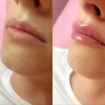 Збільшення губ