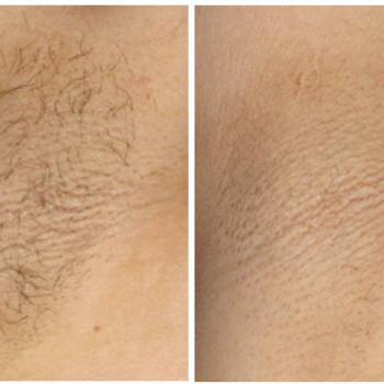 Лазерна епіляція