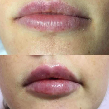 Juvederm 1 мл