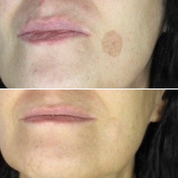 IPL терапія - видалення пігментації
                    Косметологический центр VitaLine Киев